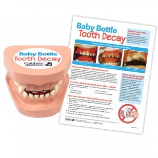 Modelis „Kūdikių dantų ėduonis - maitinimo buteliuku pasekmė“